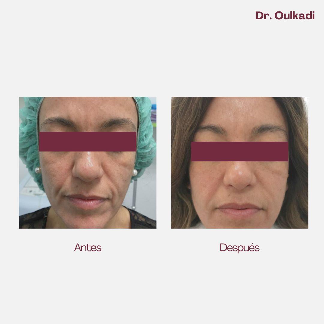 Antes y después — Restauración de volumen facial completo