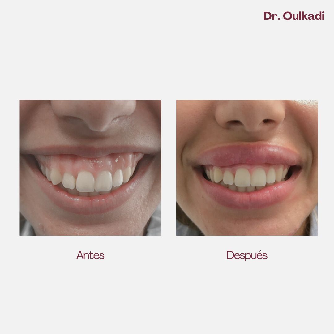 Antes y después — Corrección de sonrisa gingival